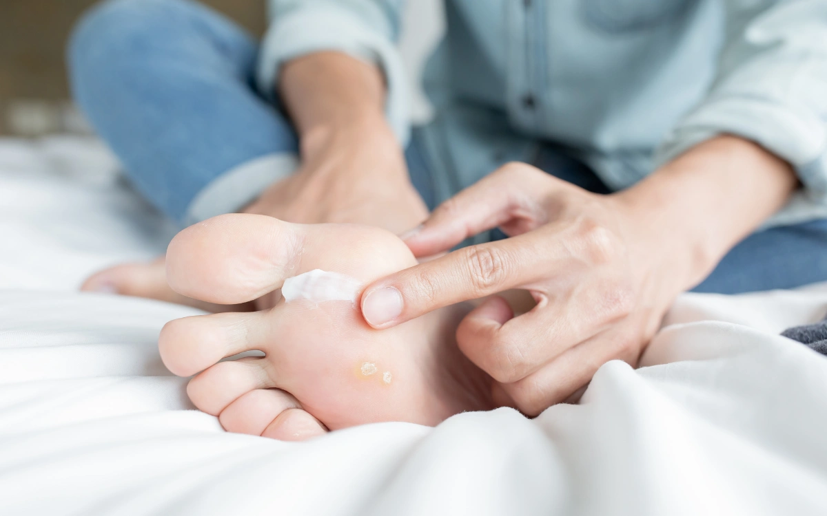 Fußpilz Behandlung mit Creme und Spray