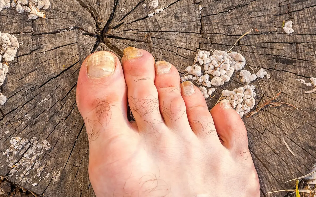 Fußpilz erkennen: Bilder und Symptome