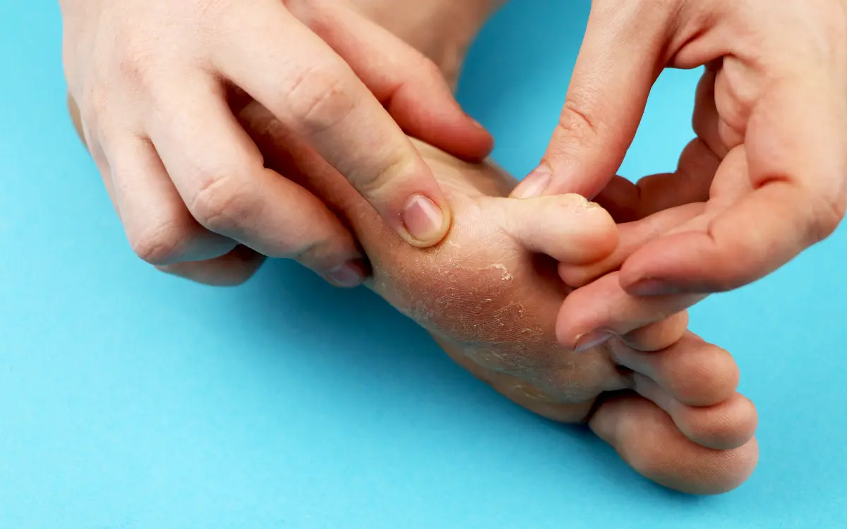 Was ist Fußpilz - Anfangsstadium