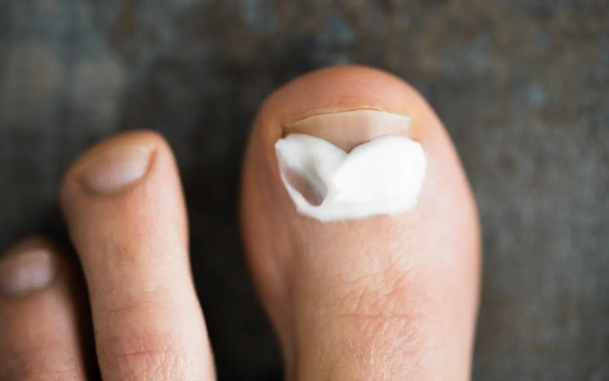 Fußpilz Behandlung Creme Anwendung richtig auftragen