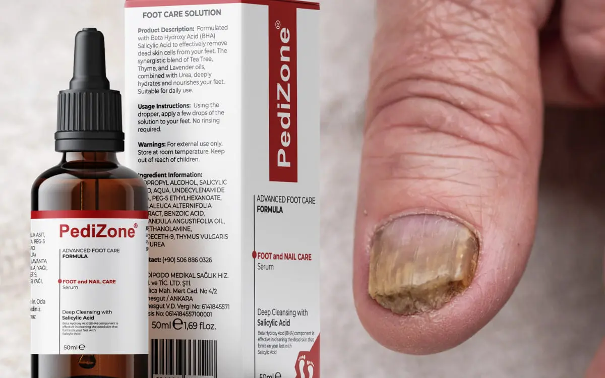 Antimykotisches Serum Fußpilz Behandlung moderne Therapie