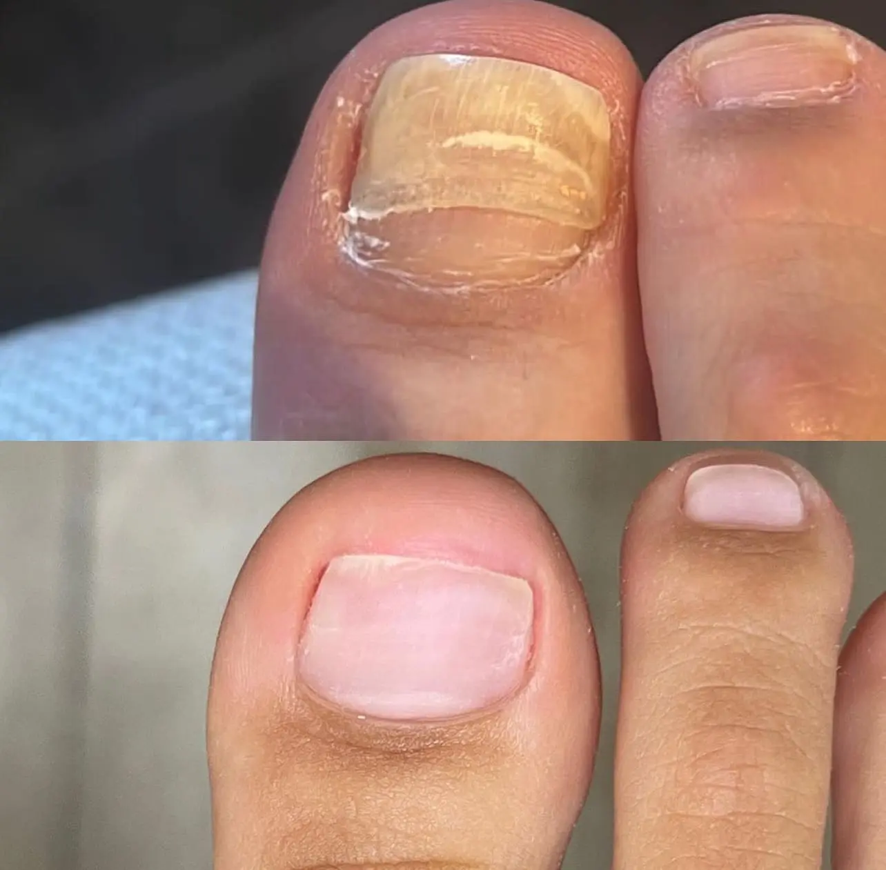 Fußpilz Behandlung Erfolg vorher nachher Vergleich Therapieergebnis