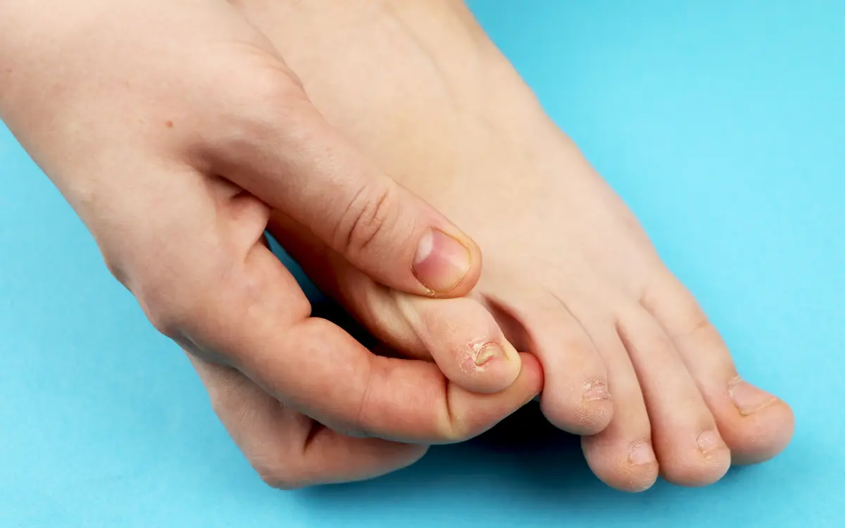 Fußpilz Symptome erkennen